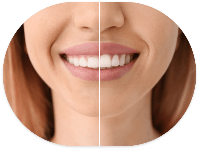 Woman smiling before and after cosmetic dentistry