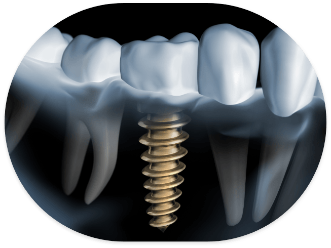 Illustrated X ray of a person with a dental implant