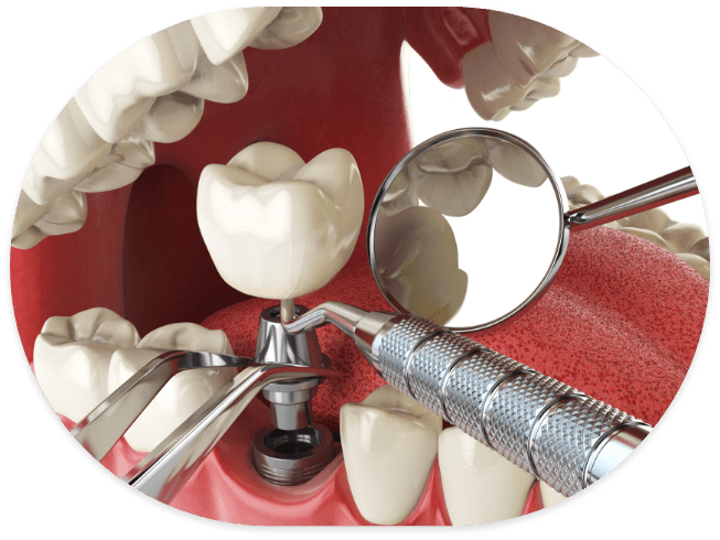 Illustrated dental implant being placed in the lower jaw