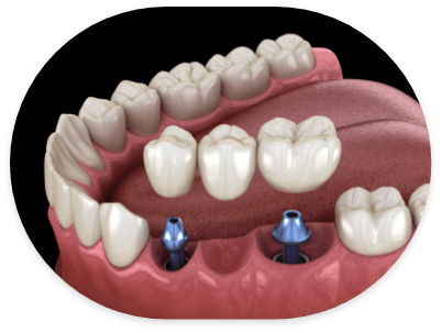 Illustrated dental bridge being placed onto two dental implants