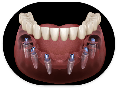 Illustrated full denture being placed onto six dental implants