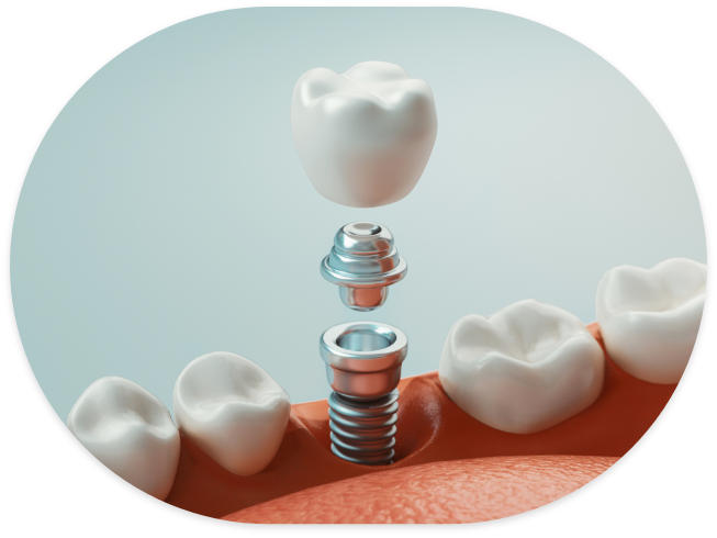 Illustrated dental implant with abutment and crown replacing a missing tooth