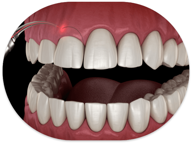 Illustrated dental laser treating a gummy smile