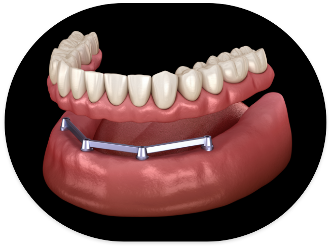 Illustration of an All on 4 implant denture
