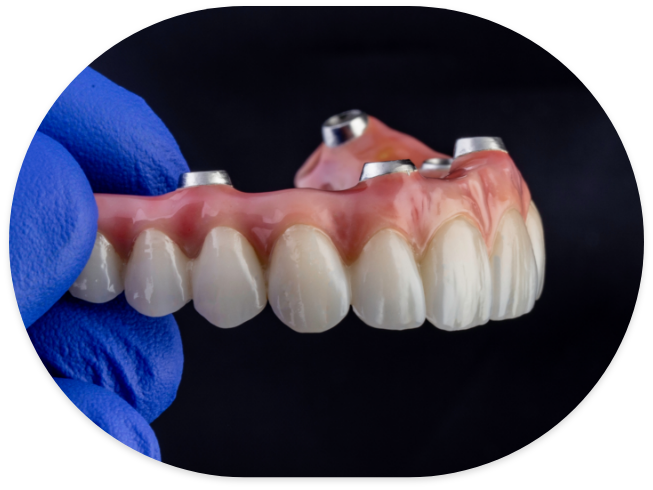 Dentist holding a full implant overdenture