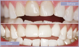 Close up of smile before and after fixing slight tooth discoloration