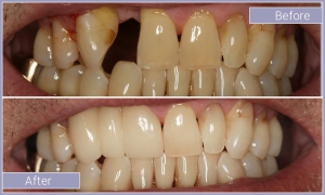 Smile before and after replacing missing tooth and whitening teeth