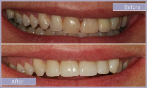 Smile before and after brightening upper row of teeth