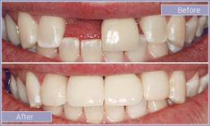 Close up of smile before and after replacing missing upper tooth