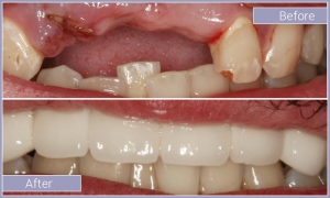 Smile before and after replacing two missing upper teeth