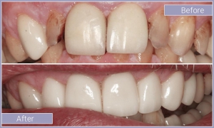 Smile before and after repairing several damaged teeth