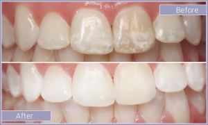 Teeth before and after correcting white spots