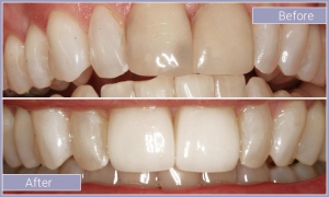 Teeth before and after correcting discoloration