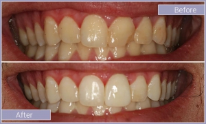 Smile before and after whitening yellowed teeth