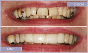 Smile before and after replacing metal restorations with tooth colored fillings