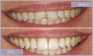 Smile before and after correcting chipped and slightly discolored teeth