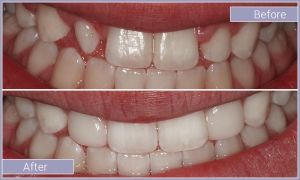 Smile before and after treating gapped teeth