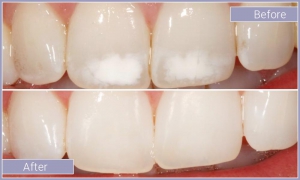 Close up of teeth before and after white stain treatment
