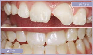 Close up of mouth before and after correcting chipped teeth