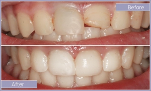 Smile before and after treating discolored and chipped teeth