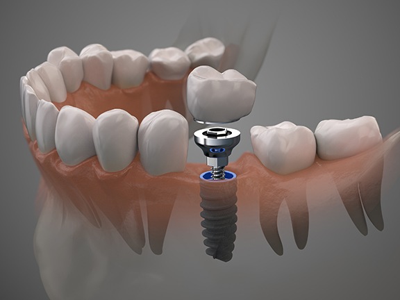 The dental implant process typically can be completed in four main steps