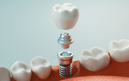 the placement of the final restoration is the last part of the dental implant process