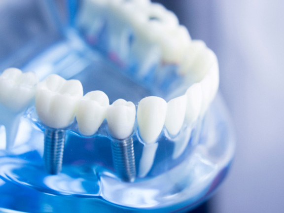 Model of All-on-X implants replacing full arch teeth 