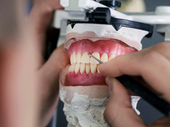 Washington patient comparing All-on-X and traditional implants