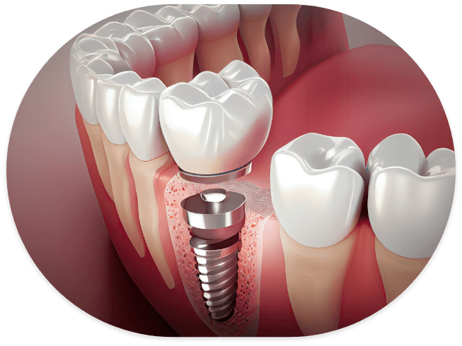 Illustrated dental implant in the lower jaw