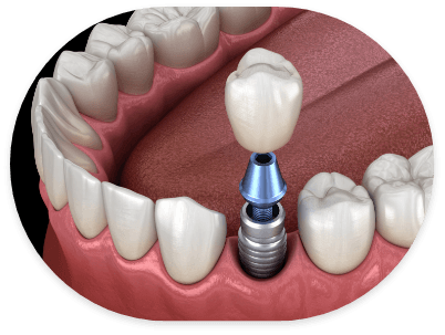 Illustrated dental crown being placed onto a dental implant