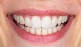 Close up of smile with brighter teeth after dental treatment