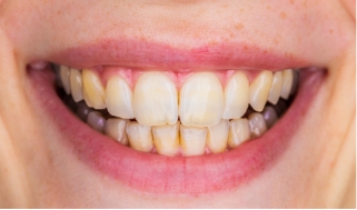 Close up of smile with discolored teeth