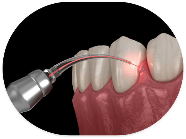 Illustrated dental laser treating gum disease