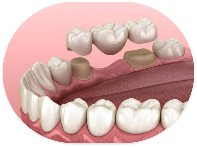 Illustrated dental bridge replacing a missing tooth