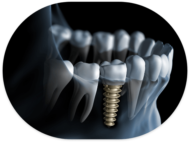 Illustrated X ray of a person with a dental implant