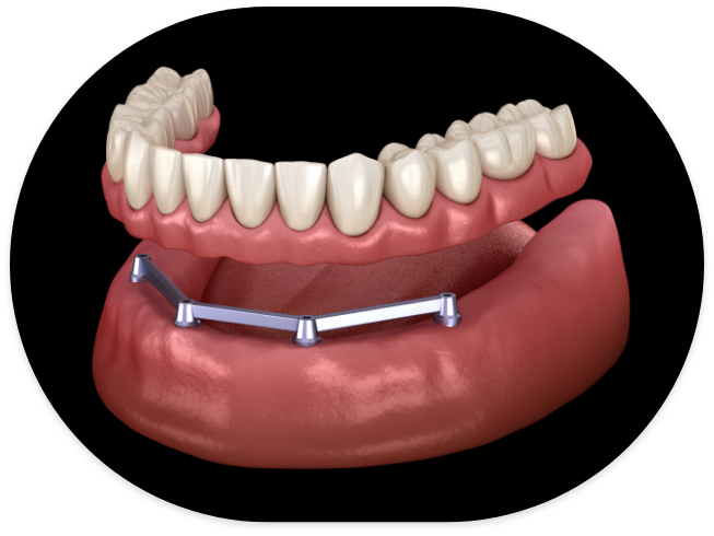 Dentist holding a full implant overdenture