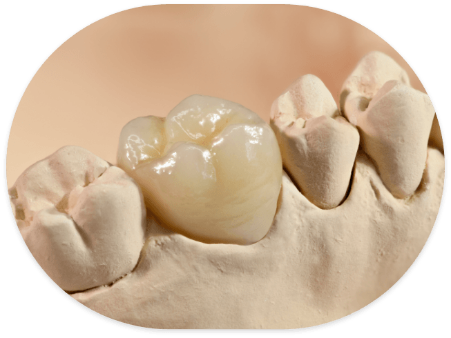 Model of the mouth with a dental crown over one tooth