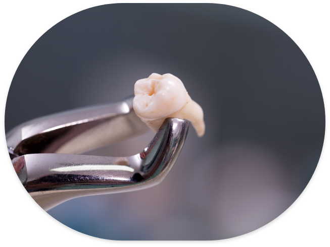 Dental forceps holding an extracted tooth