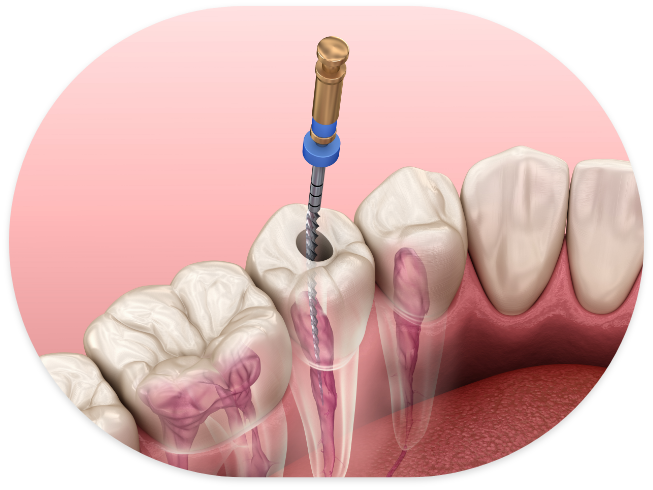 Illustrated dental instrument cleaning the inside of a tooth