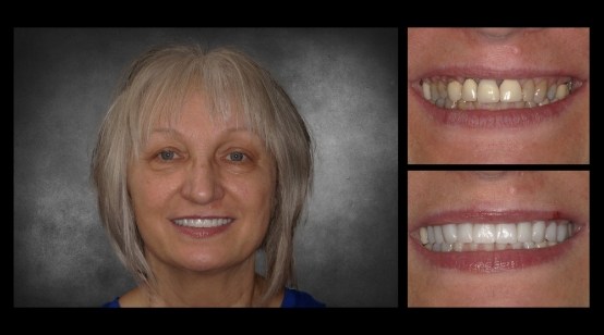 Close up of smile before and after fixing slight tooth discoloration