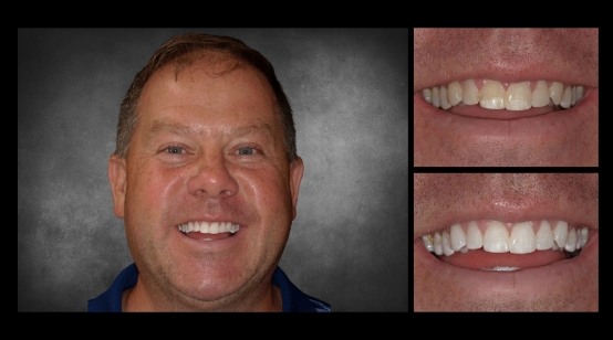 Smile before and after replacing missing tooth and whitening teeth