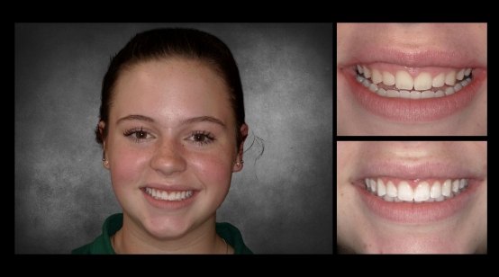 Smile before and after brightening upper row of teeth