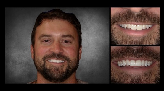 Close up of smile before and after replacing missing upper tooth