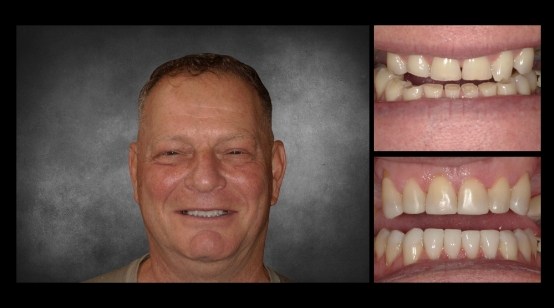 Smile before and after replacing two missing upper teeth