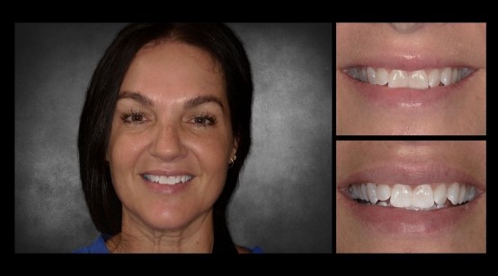 Teeth before and after correcting white spots