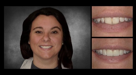 Teeth before and after correcting discoloration