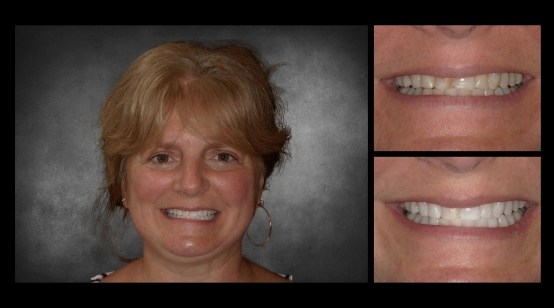 Smile before and after whitening yellowed teeth