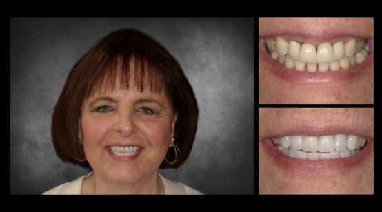 Smile before and after replacing metal restorations with tooth colored fillings