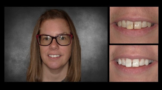 Smile before and after correcting chipped and slightly discolored teeth