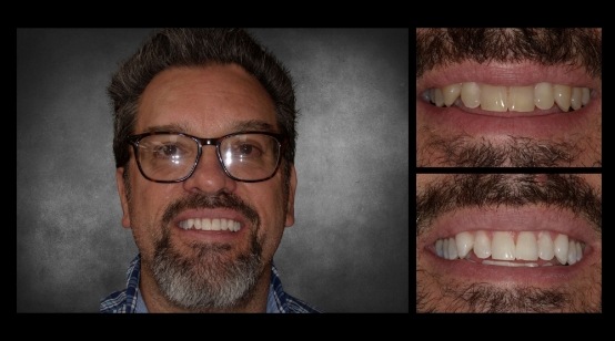 Smile before and after teeth whitening